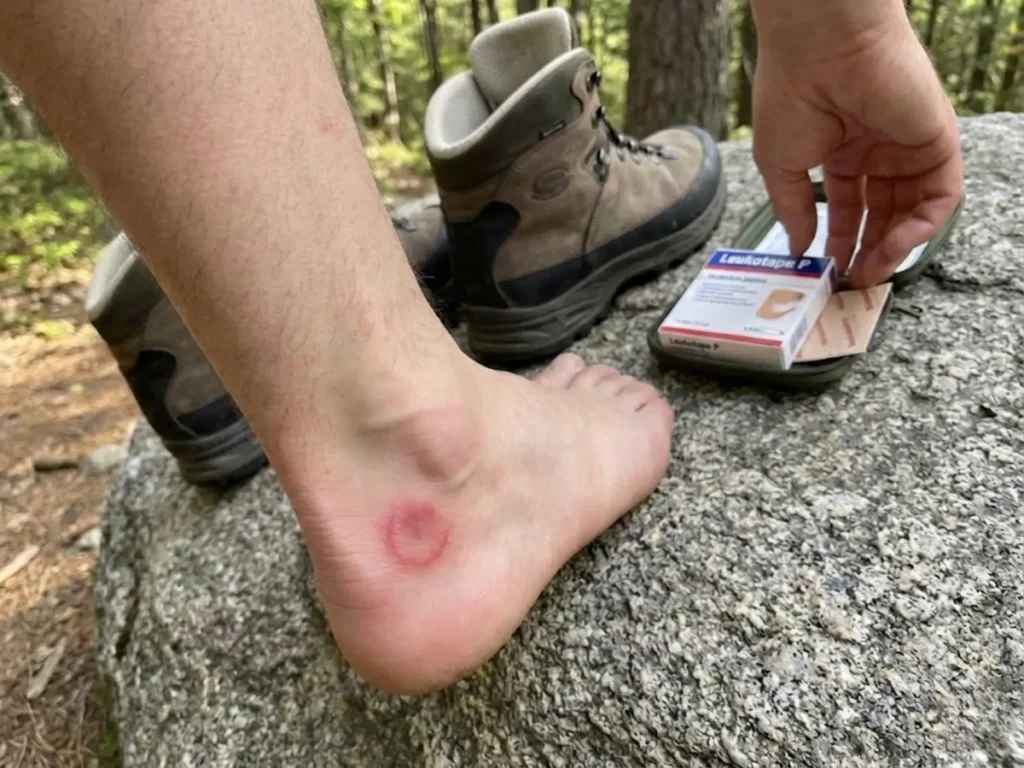 Hiking blister hot spot caused by sock bunching failure mode requiring trail treatment
